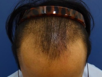 薄毛治療 発毛症例 29歳/M型/初診時