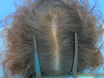 薄毛治療 発毛症例 64歳/頭頂部/初診時