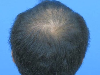 薄毛治療 発毛症例 24歳/MO型/初診時