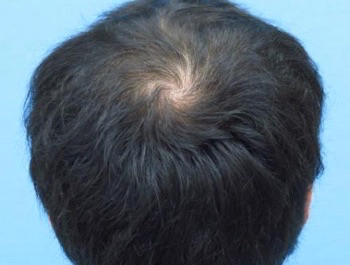 薄毛治療 発毛症例 24歳/MO型/4ヶ月後