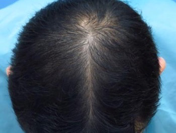 薄毛治療 発毛症例 35歳/MO型/14ヶ月後