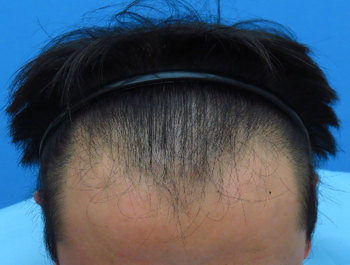 薄毛治療 発毛症例 40歳/M型/初診時