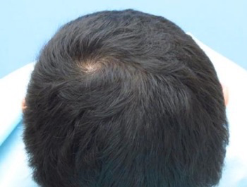 薄毛治療 発毛症例 37歳/O型/10ヶ月後