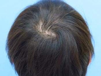薄毛治療 発毛症例 38歳/MO型/初診時