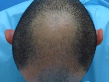 薄毛治療 発毛症例 34歳/MO型/初診時