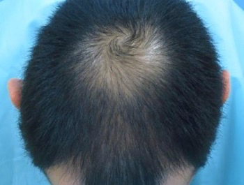 薄毛治療 発毛症例 34歳/MO型/6ヶ月後