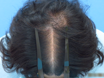 薄毛治療 発毛症例 54歳/頭頂部/初診時