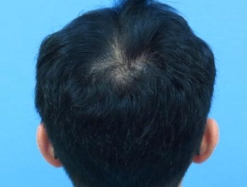 薄毛治療 発毛症例 36歳/MO型/7ヶ月後