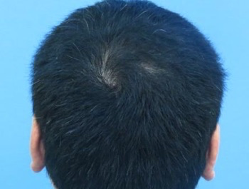 薄毛治療 発毛症例 37歳/MO型/6ヶ月後