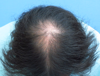 薄毛治療 発毛症例 32歳/MO型/初診時