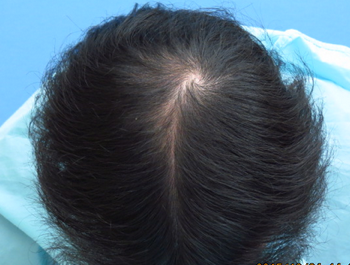 薄毛治療 発毛症例 32歳/MO型/4ヶ月後