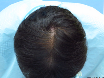 薄毛治療 発毛症例 29歳/MO型/初診時