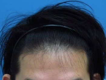 薄毛治療 発毛症例 30歳/O型/初診時