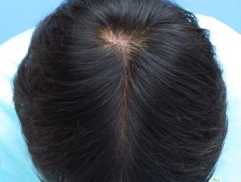 薄毛治療 発毛症例 34歳/MO型/4ヶ月後