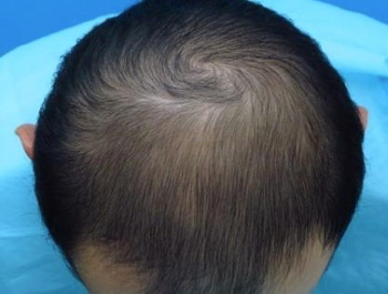 薄毛治療 発毛症例 41歳/MO型/6ヶ月後