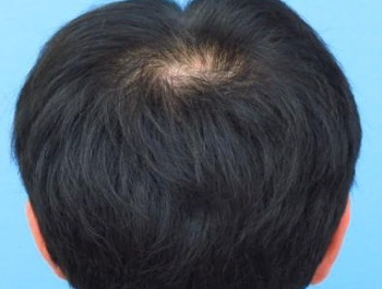 薄毛治療 発毛症例 29歳/MO型/7ヶ月後