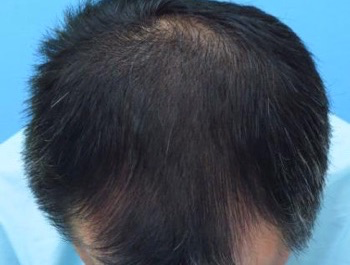 薄毛治療 発毛症例 45歳/MO型/5ヶ月後