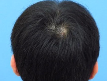 薄毛治療 発毛症例 32歳/MO型/4ヶ月後
