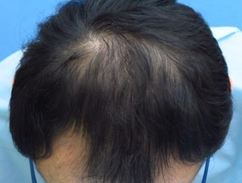 薄毛治療 発毛症例 53歳/MO型/6ヶ月後