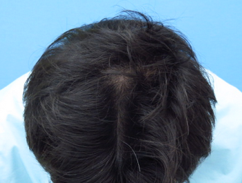 薄毛治療 発毛症例 40歳/MO型/7ヶ月後