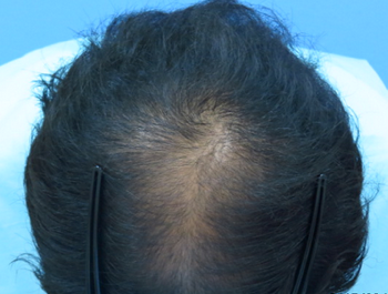 薄毛治療 発毛症例 25歳/MO型/初診時
