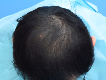 薄毛治療 発毛症例 55歳/MO型/4ヶ月後