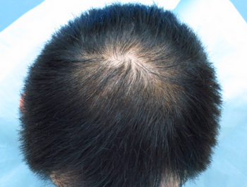 薄毛治療 発毛症例 46歳/MO型/8ヶ月後