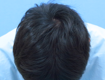 薄毛治療 発毛症例 28歳/MO型/6ヶ月後
