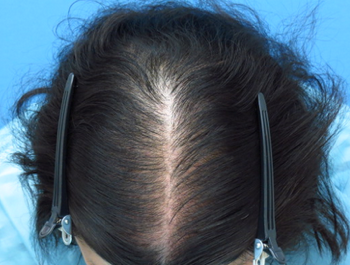 薄毛治療 発毛症例 34歳/頭頂部/初診時