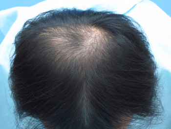 薄毛治療 発毛症例 27歳/MO型/初診時