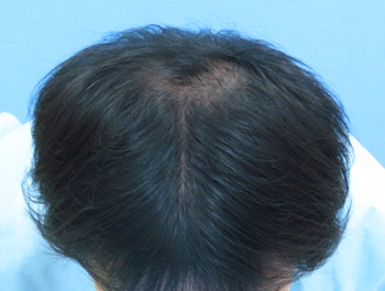薄毛治療 発毛症例 27歳/MO型/4ヶ月後