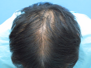 薄毛治療 発毛症例 28歳/MO型/初診時
