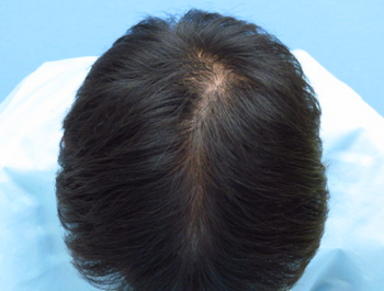 薄毛治療 発毛症例 28歳/MO型/6ヶ月後