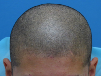 薄毛治療 発毛症例 27歳/M型/初診時