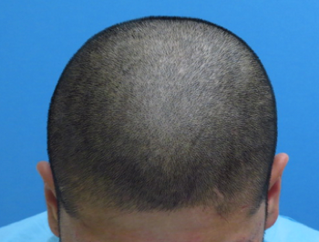 薄毛治療 発毛症例 27歳/M型/7ヶ月後