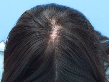 薄毛治療 発毛症例 31歳/頭頂部/10ヶ月後