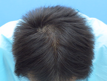 薄毛治療 発毛症例 42歳/MO型/9ヶ月後