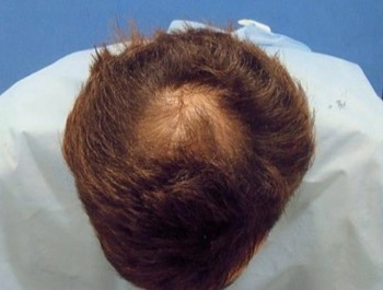 薄毛治療 発毛症例 34歳/O型/初診時