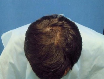 薄毛治療 発毛症例 34歳/O型/11ヶ月後