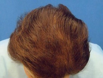 薄毛治療 発毛症例 73歳/全体/9ヶ月後