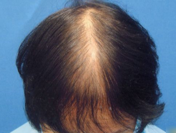 薄毛治療 発毛症例 64歳/全体/初診時