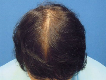 AGA治療例:64歳/全体/薄毛歴2年/介護　ヘルパー/5ヶ月後