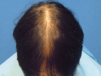 薄毛治療 発毛症例 64歳/全体/11ヶ月後