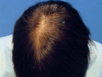 薄毛治療 発毛症例 37歳/頭頂部/11ヶ月後