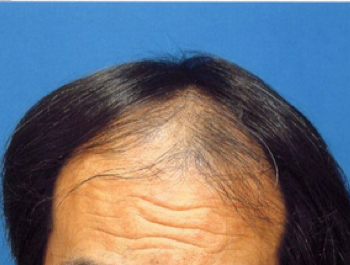 薄毛治療 発毛症例 61歳/M型/初診時