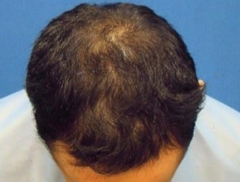 薄毛治療 発毛症例 26歳/MO型/9ヶ月後
