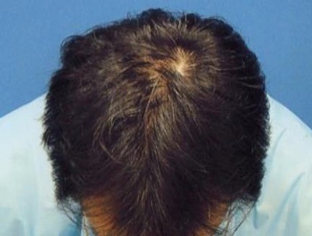 薄毛治療 発毛症例 43歳/MO型/7ヶ月後