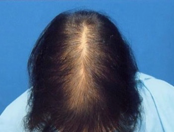 薄毛治療 発毛症例 45歳/頭頂部/初診時