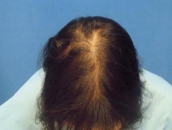 AGA治療例:45歳/頭頂部/薄毛歴10年/主婦/3ヶ月後