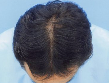 薄毛治療 発毛症例 39歳/O型/7ヶ月後